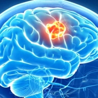 Un virus capaz de combatir el tumor cerebral