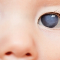 Alrededor de 105 extremeños padecen Glaucoma Congénito