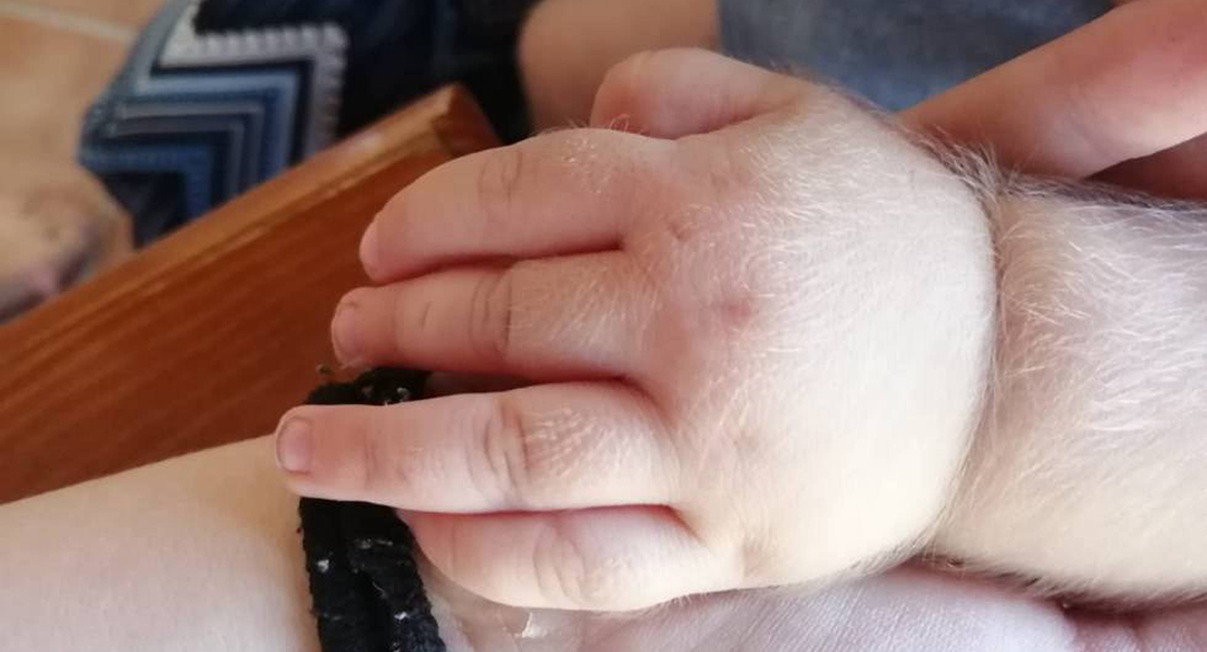 El "síndrome del hombre lobo" afecta a 17 bebés debido a un envasado erróneo de omeprazol