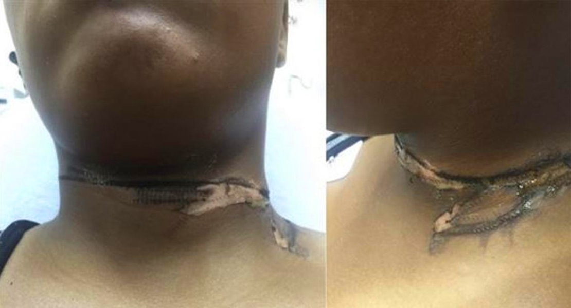 Una joven se quema el cuello con el cargador de su iPhone