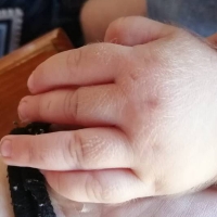 El "síndrome del hombre lobo" afecta a 17 bebés debido a un envasado erróneo de omeprazol