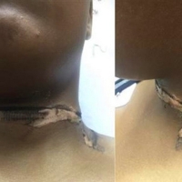 Una joven se quema el cuello con el cargador de su iPhone