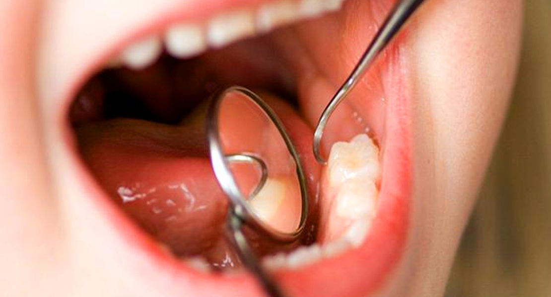 Los daños colaterales del Covid-19: Dientes desgastados, astillados e incluso rotos