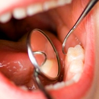 Los daños colaterales del Covid-19: Dientes desgastados, astillados e incluso rotos