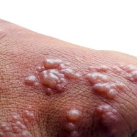 Erupción de herpes Zóster: un efecto adverso de la vacuna contra la Covid Erupción de herpes Zóster: un efecto adverso de la vacuna contra la Covid
