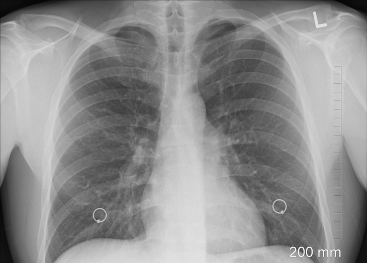 El 50% de los pacientes Covid sufren post complicaciones respiratorias