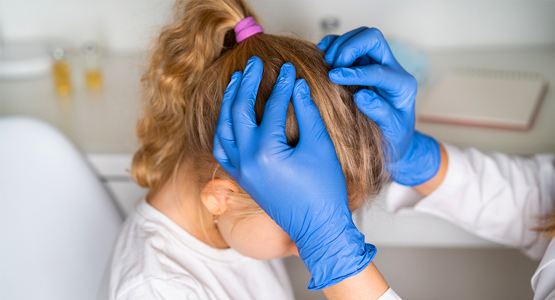 ESTUDIO: Qué tratamientos usar contra los piojos