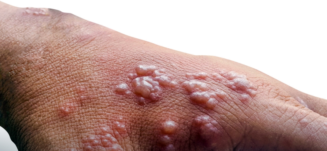 La importancia de la vacunación contra el herpes zóster