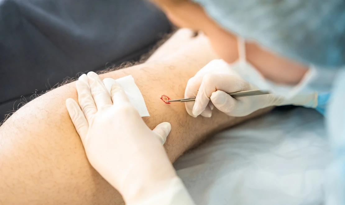 Trabajan para que una herramienta innovadora de IA pueda diagnosticar enfermedades de la piel