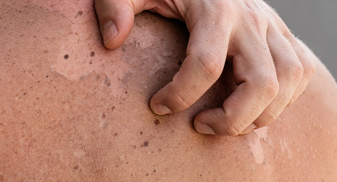 Cómo prevenir el cáncer de piel: "Es la única manera de evitarlo"