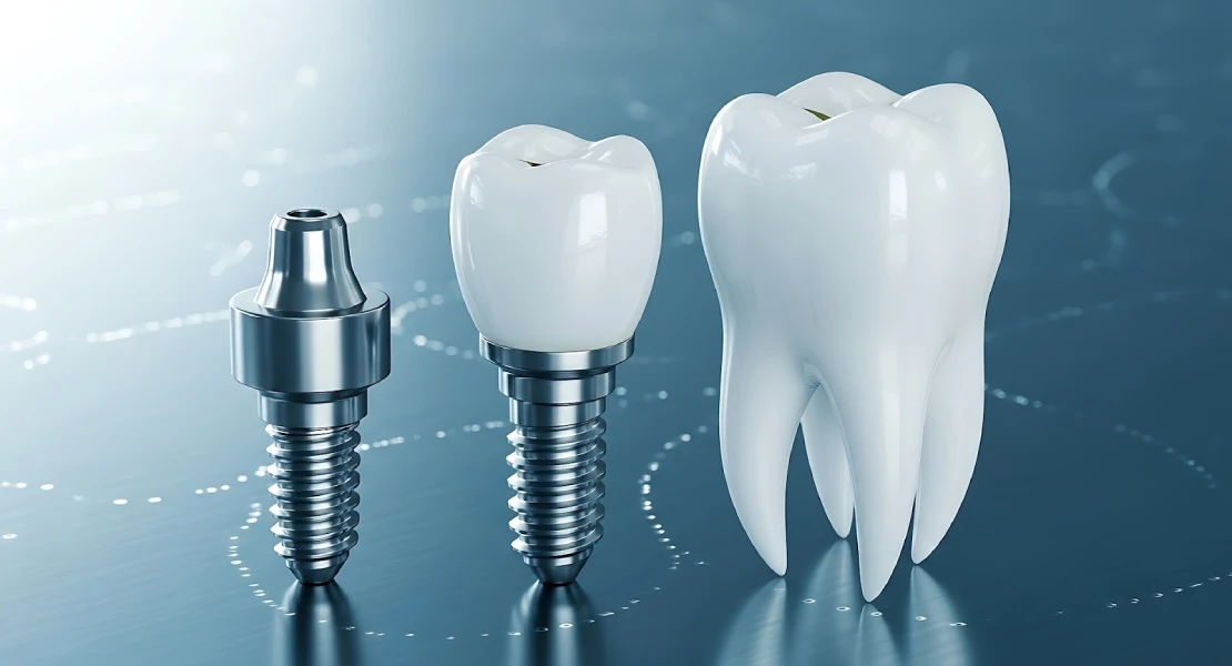 Implantes dentales en Mérida: recupera la sonrisa en la Clínica Dental Gema Villalba