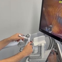 El Hospital Universitario de Cáceres realiza la primera cirugía robótica de pared abdominal